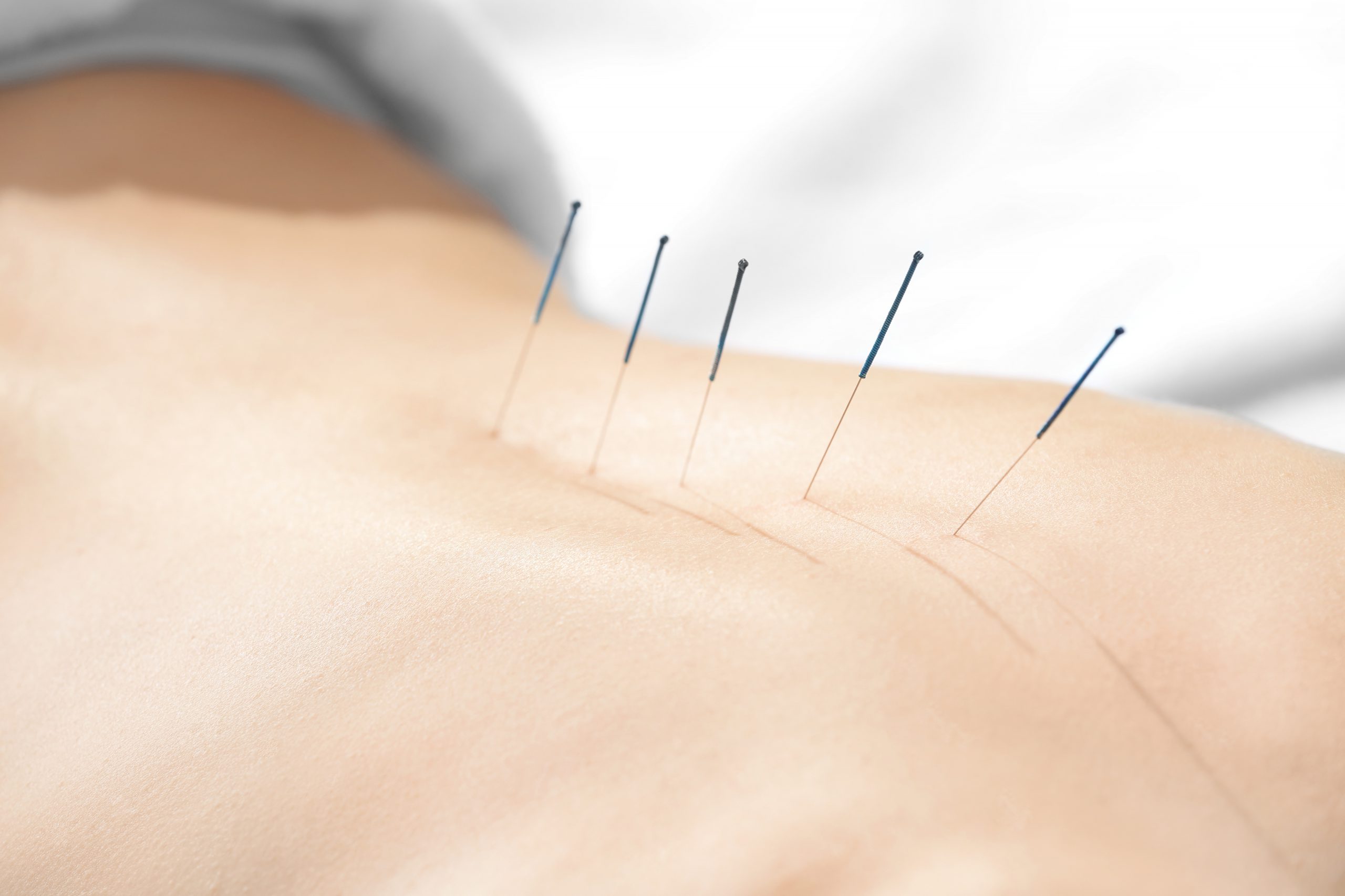 ฝังเข็มแบบจีน (Acupuncture)