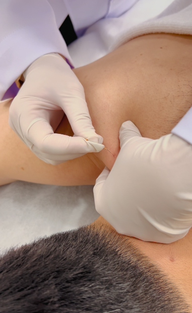 ฝังเข็มตะวันตก (Dry Needling)